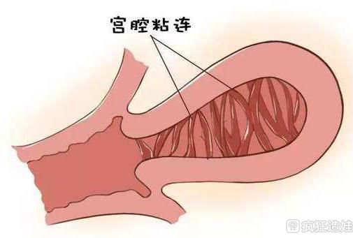 宫腔粘连是否会影响怀孕？能做第四代试管婴儿吗？